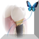 Experte Zahnimplantate Berlin Dr. Stoltenburg M.Sc.,M.Sc.,MPI /Tätigkeitsschwerpunkt Implantologie