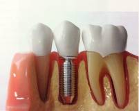 Experte Zahnimplantate Berlin Dr. Stoltenburg / Implantatprothetik