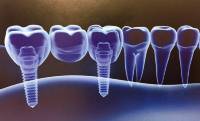 Experte Zahnimplantate Berlin Dr. Stoltenburg / Implantatprothetik