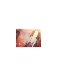 Bild 05 Experte Zahnimplantate Berlin Dr. Stoltenburg /Knochenblock&quot;