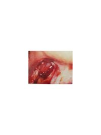 Bild 06 Experte Zahnimplantate Berlin Dr. Stoltenburg / Knochenblock&quot;