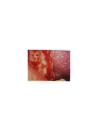 Bild 07 Experte Zahnimplantate Berlin Dr. Stoltenburg / Knochenblock&quot;