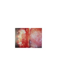Bild 09 Experte Zahnimplantate Berlin Dr. Stoltenburg / Knochenblock&quot;