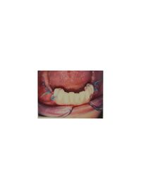 Bild 10 Experte Zahnimplantate Berlin Dr. Stoltenburg / Knochenblock&quot;